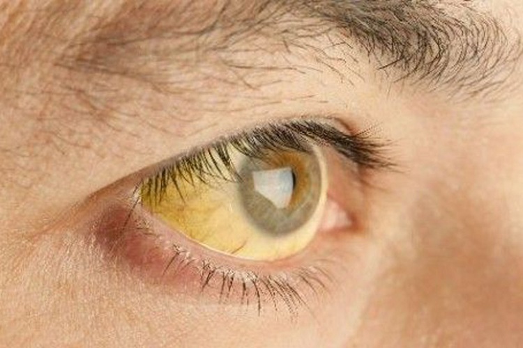 Foto: Archivo / Son los tipos B y C la causa más común de cirrosis y cáncer en el hígado. El principal síntoma es coloración amarillenta de piel y ojos (ictericia), fatiga y orina oscura.